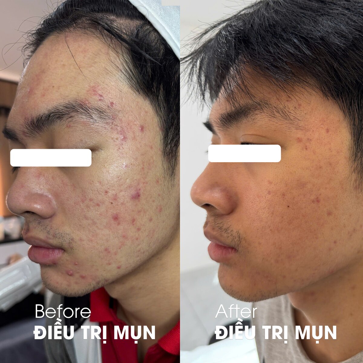 Ca điều trị mụn viêm tại DrSkin — ảnh trước và sau, đã ẩn danh