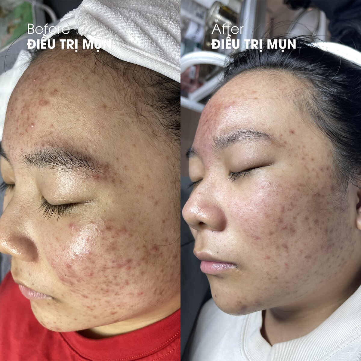 Ca điều trị mụn viêm - nang tại DrSkin — ảnh trước và sau, đã ẩn danh