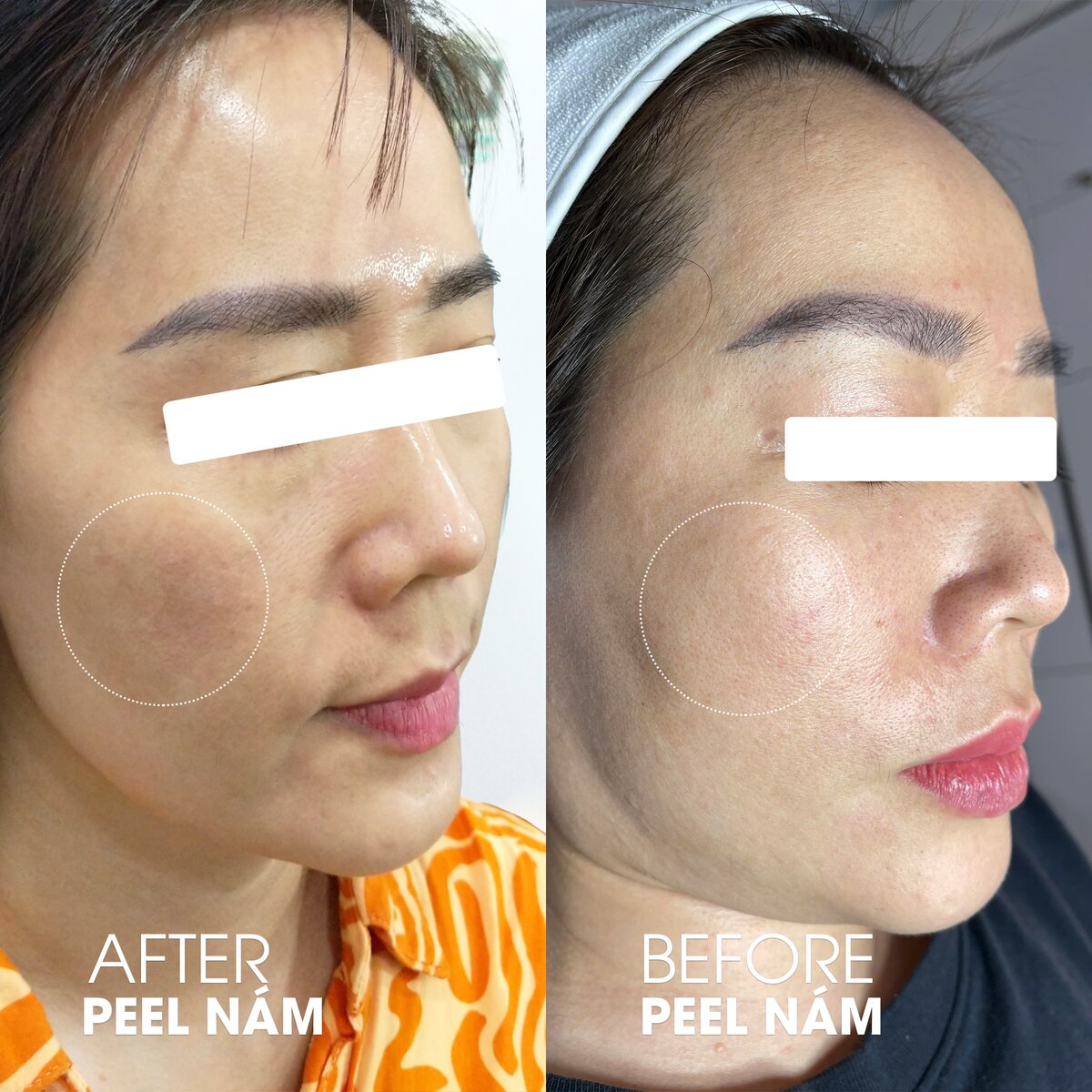 Ca điều trị nám bằng peel chuẩn y khoa tại DrSkin — ảnh trước và sau, đã ẩn danh