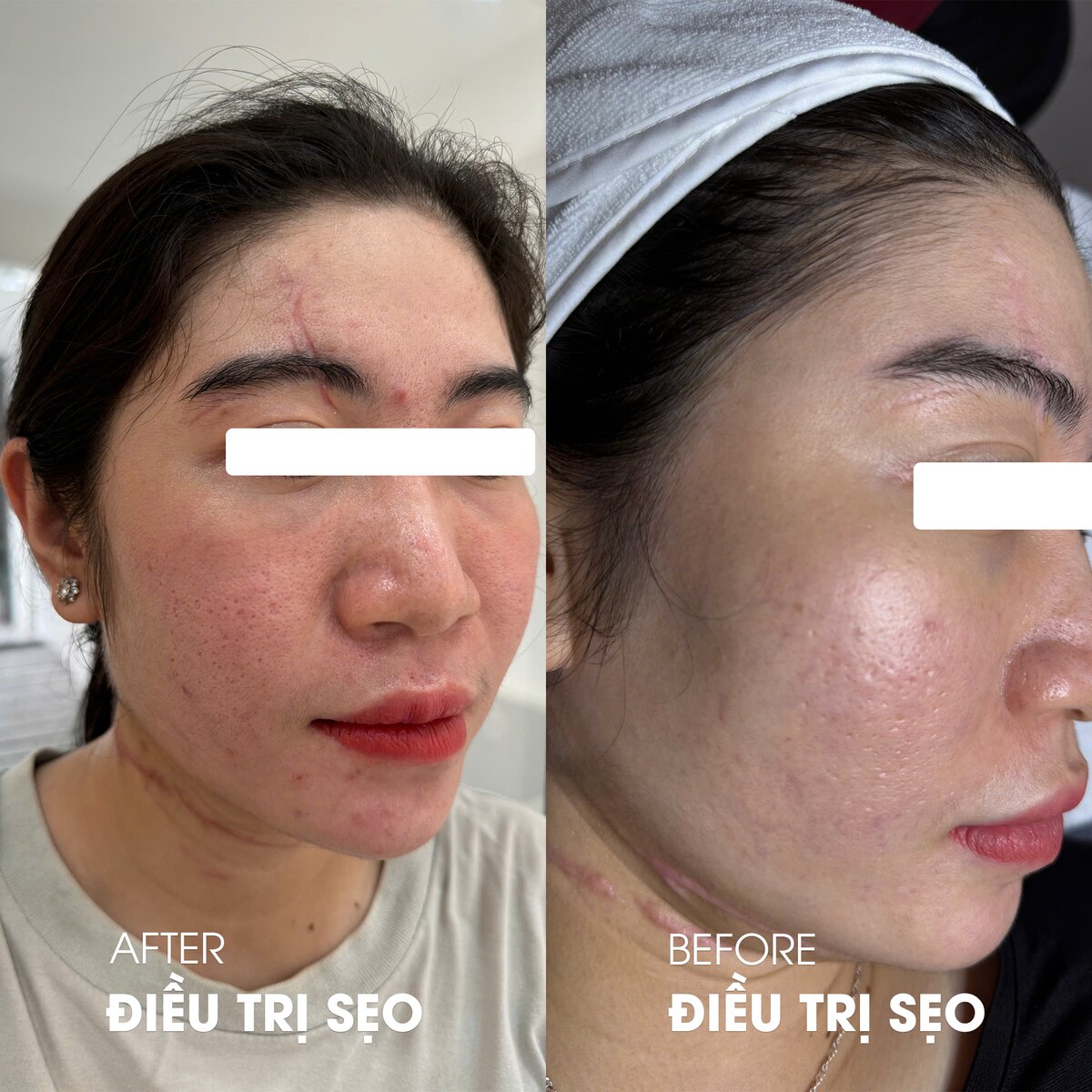 Ca điều trị sẹo rỗ và thâm sau mụn tại DrSkin — ảnh trước và sau, đã ẩn danh