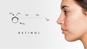 Điều trị mụn trứng cá do nội tiết bằng retinol