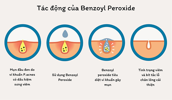 Tác động trị mụn của Benzoyl Peroxide
