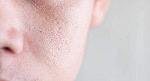 Sẹo rỗ khiến nhiều người tự ti về làn da