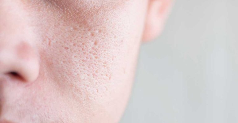 Sẹo rỗ khiến nhiều người tự ti về làn da
